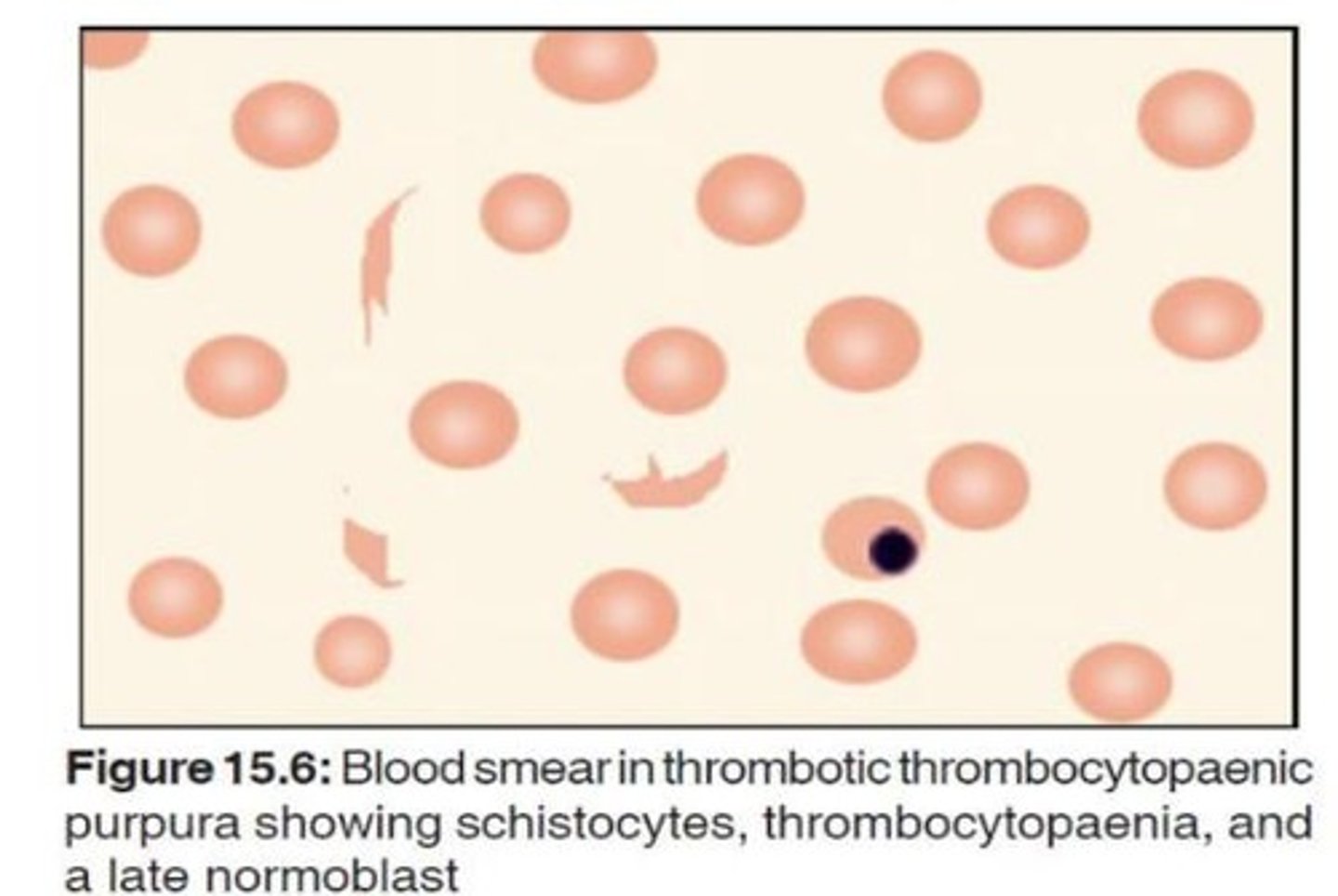 <p>Anemia due to small blood vessel damage.</p>