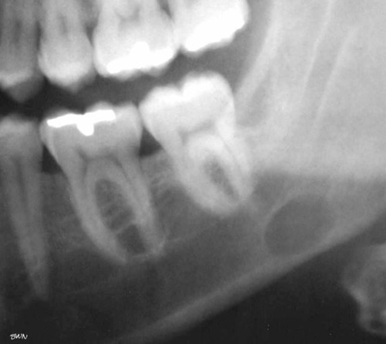 <p>what is your diagnosis?</p><p>- Located between inferior alveolar nerve canal and inferior border of mandible</p><p>- Oval/round/elliptical shape</p><p>- Well-circumscribed radiolucency</p><p>- Dense sclerotic corticated (radiopaque border) usually on the superior aspect</p>