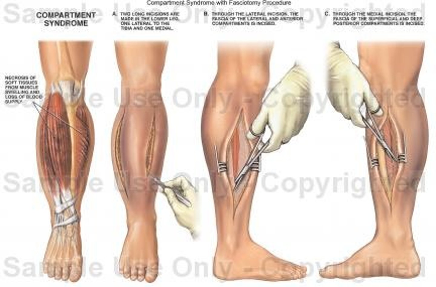 <p>is a surgical incision through the fascia to relieve tension or pressure. Without this procedure, which is commonly used to treat compartment syndrome, the pressure causes a loss of circulation that damages the affected tissues.</p>
