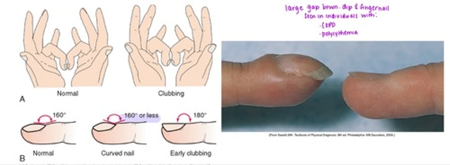 <p>- large gap btwn. DIP &amp; fingernail i.e. 160 degrees or less; seen in individuals with COPD, polycythemia</p>