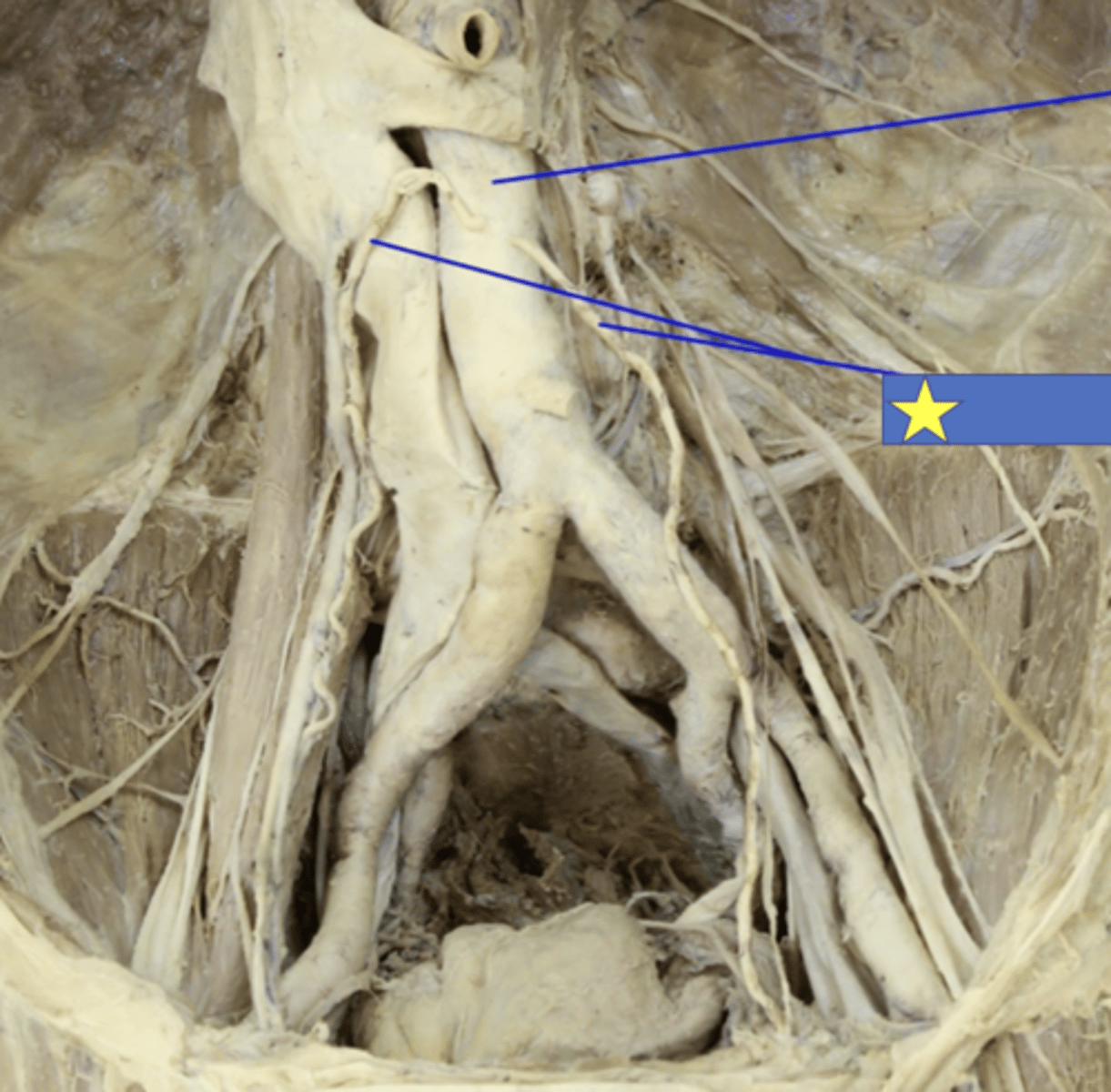 <p>ID Star, assume pt is male</p>
