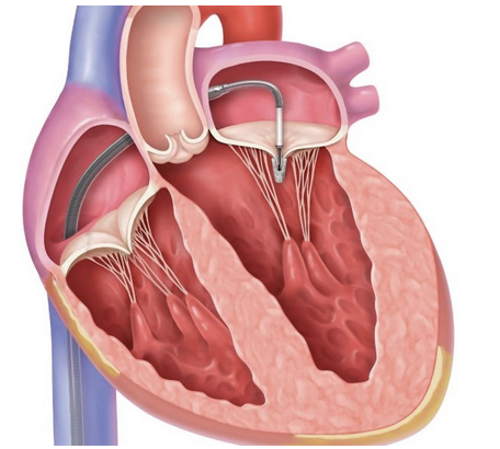 <p>What procedure is this referring to?</p>