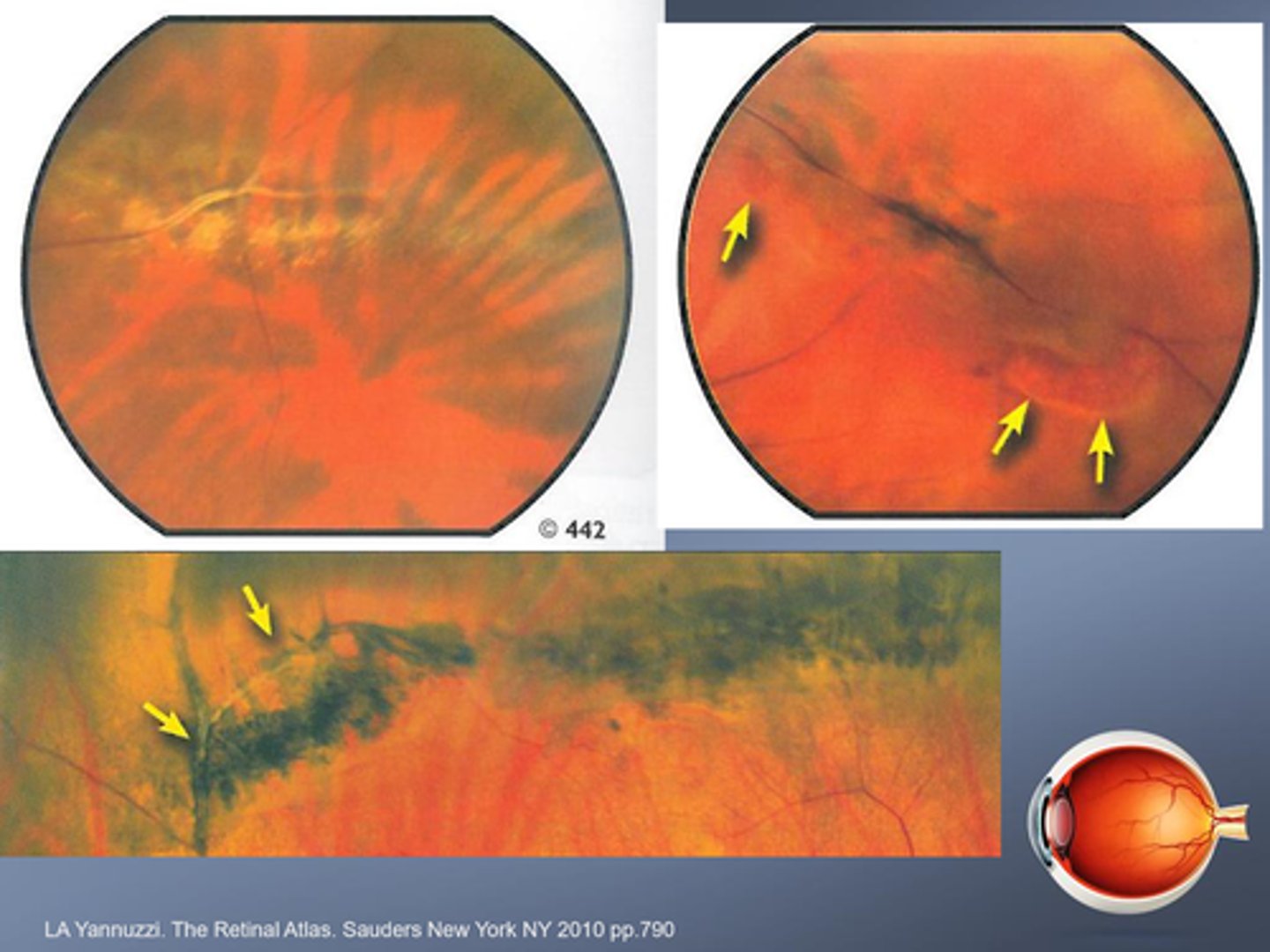 <p>inner retinal layer thinning with... </p><p>abnormal pigmentation</p><p>RPE hyperplasia </p><p>attenuated/sheathed BV</p><p>strong vitreal adhesion at edge = increased risk of tears/holes</p>