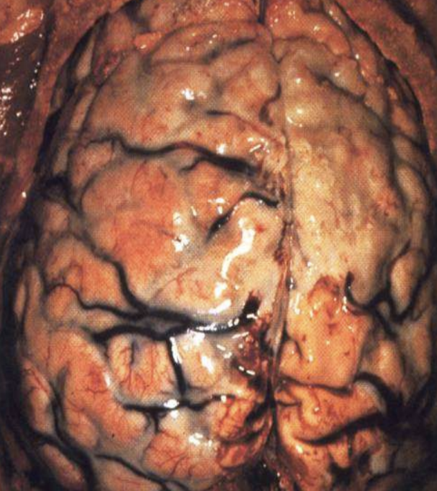 <p>Purulent (Suppurative) inflammation</p>