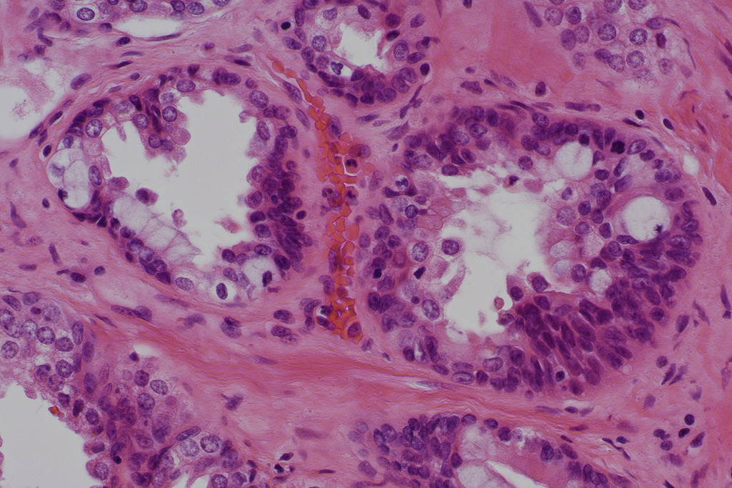  A 71-year-old African American man visits his physician

for a checkup because he is worried about his family history of prostate cancer. Physical examination does not indicate any abnormalities. Because of the patient’s age and family history, his prostate-specific antigen (PSA) level is measured and is 8 ng/mL. Six months later, the PSA level is 10 ng/mL. A urologist obtains transrectal biopsy specimens, and microscopic examination shows multifocal areas of glandular hyperplasia and the appearance shown in the figure. Which of the following statements applies best to this clinical and pathologic scenario?

 