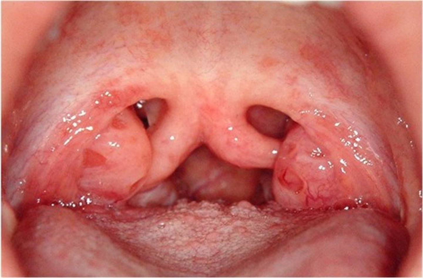 <p>Bifid uvula</p>