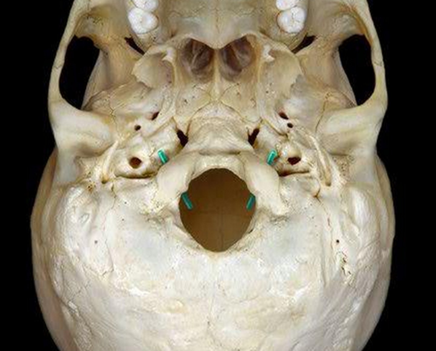 <p>Hypoglossal (CN XII) runs through, inner aspect of occipital condyle</p>