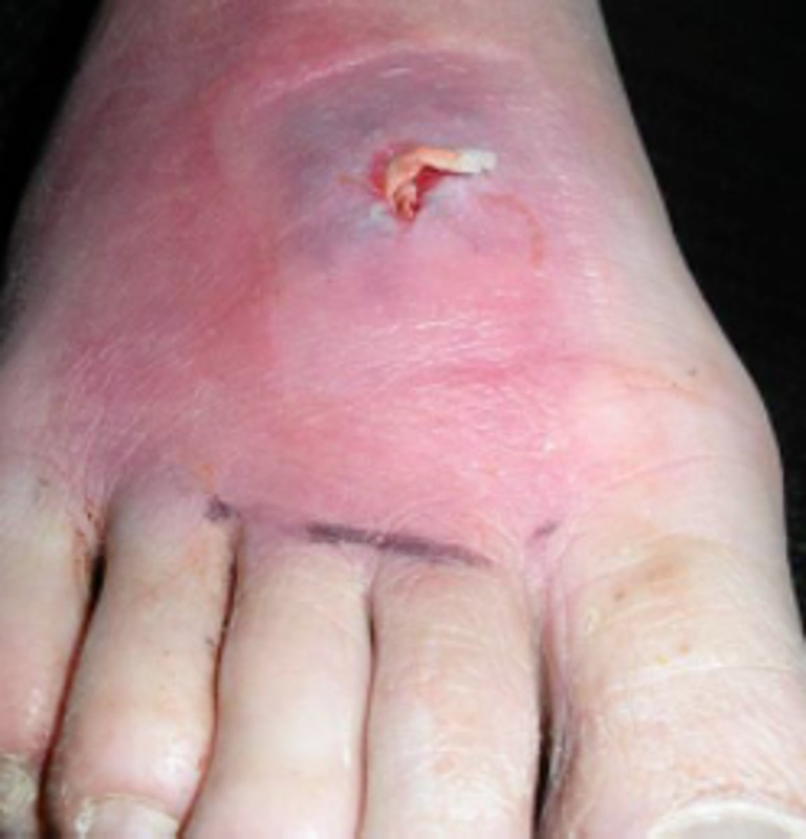 <p>abscess (tályog)</p>