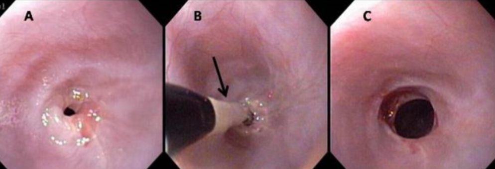 <p>success rate about 85%, may need canned or slurry diet</p>