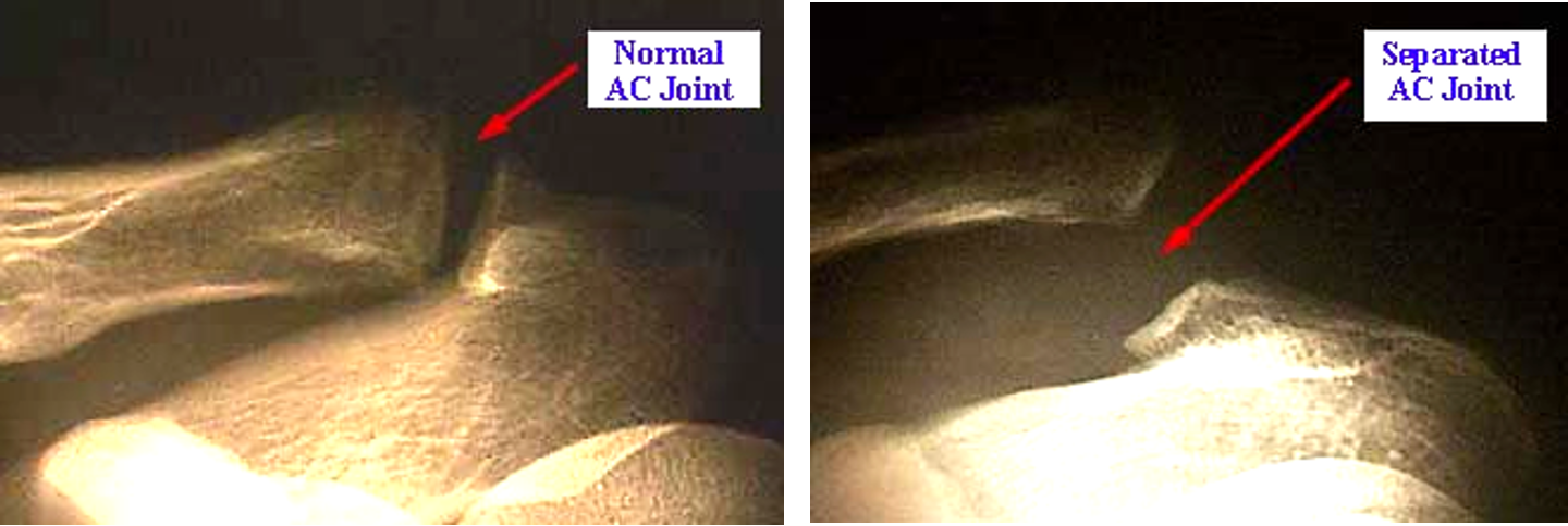 <p>the ligament of the AC joint is disrupted, resulting in 5 degrees of AC separation </p>