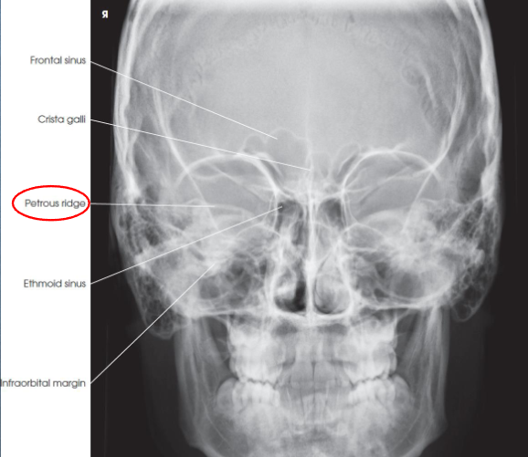 <ul><li><p>shows:</p><ul><li><p>orbital rims</p></li><li><p>maxillae</p></li><li><p>nasal septum</p></li><li><p>zygomatic bones</p></li><li><p>anterior nasal spine</p></li><li><p>petrous ridges in lower third of orbits (caused be 15 degree caudal angle)</p></li></ul></li><li><p>entire orbits and facial bones</p></li><li><p>no rotation or tilt:</p><ul><li><p>equal distances from lateral borders of skull and lateral borders of orbits</p></li><li><p>MSP of head alligned with long axis of collimated field</p></li></ul></li><li><p>symmetric petrous ridges</p></li></ul><p></p>