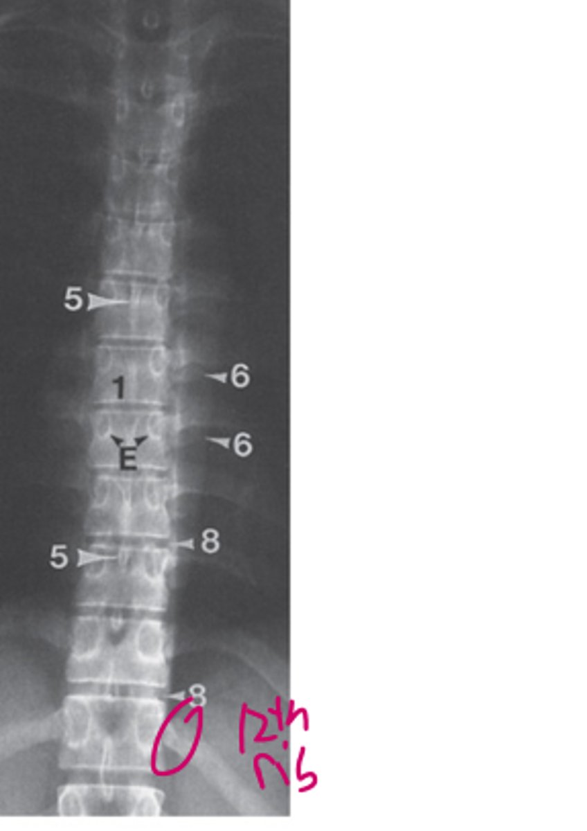 <p>1=vertebral body</p><p>5=spinous process</p><p>6=transverse process</p><p>8=intervertebral disc space</p><p>E=pedicle</p>