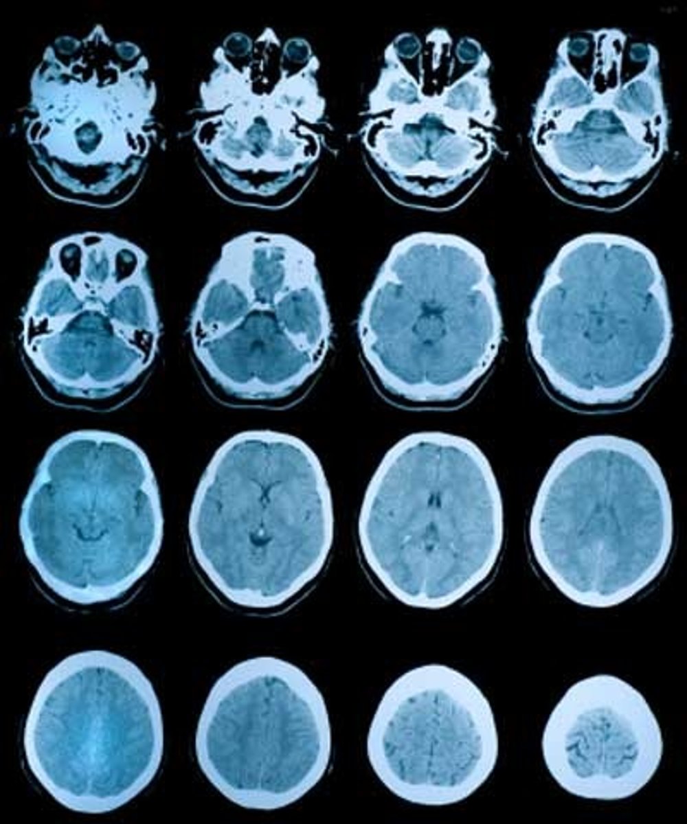 <p>x-ray imaging produces cross-sectional and other views of anatomic structures (looking from the direction of feet to head) --&gt; equivalent radiation does of 100-200 simple chest x-rays</p>