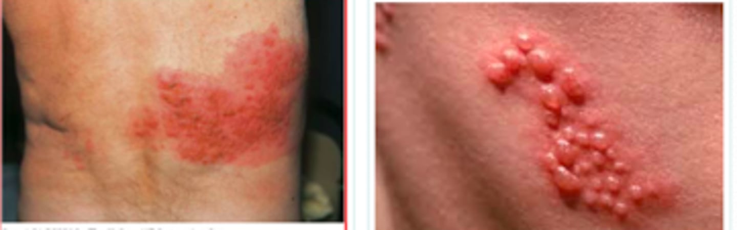 <p>Viral Skin Infections:</p><p>If a pt presented w the following S/S, what may we suspect they have:</p><p>- neuritic pain or paresthesias for 2-3 weeks prior</p><p>- <strong>allodynia</strong> (heightened sensation to mild stimuli)</p><p>- headache, malaise, fever</p><p>-<strong> papules (24h) --&gt; vesicles/bullae (48h) --&gt; pustules (96h) --&gt; crusts (7-10 days)</strong> forming over 1 week within 1<strong> unilateral, dermatomal distributio</strong>n</p>