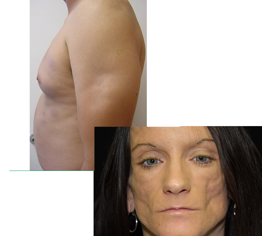 <ul><li><p>presents as painful indurates plaques or firm SC nodules</p></li><li><p>upon resolution → SC atrophy and scarring</p></li><li><p><u>location:</u> scalp, face, upper arms, chest, breasts, lower back, flank, upper thighs, or buttocks</p></li></ul><p></p>