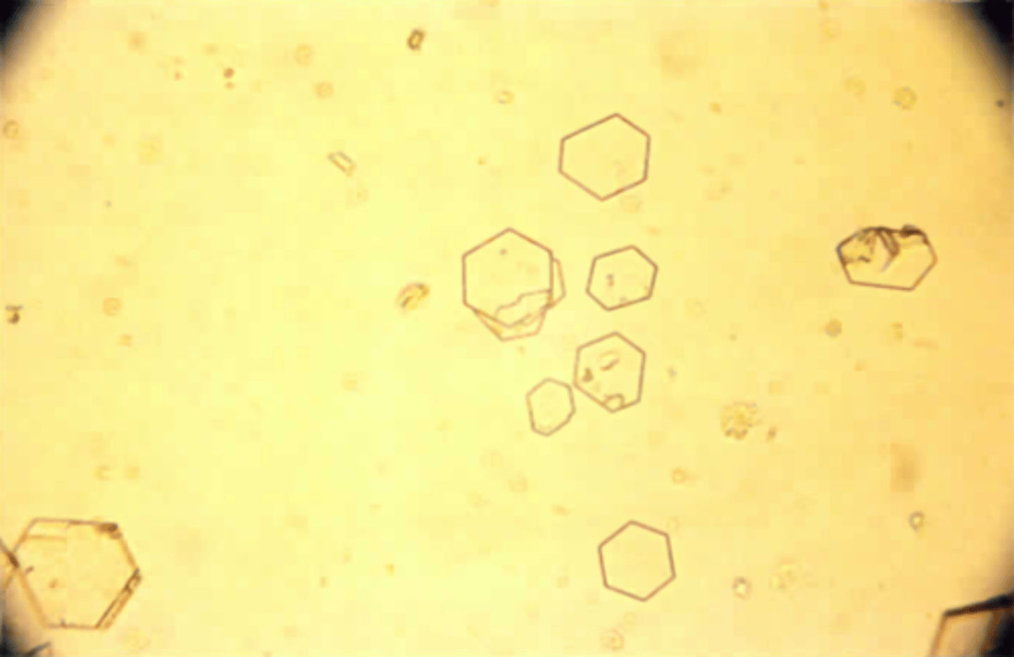 <p>B. Ornithine and arginine</p><p>The presence of cystine crystals in a patient sample is always a cause for immediate notification of the physician. Cystinuria is an autosomal recessive disorder characterized by the inability to reabsorb the amino acids cystine, lysine, arginine, and ornithine in either the renal tubules or the intestine. Cystine will crystallize in acid pH more readily than the other amino acids. Tyrosine forms needle-shaped crystals whereas leucine will appear round and oily with concentric rings. Isoleucine and phenylalanine will not form crystals in the urine. Acetoacetate and B- hydroxybutyric acid are two ketone bodies that will be soluble in the sample and give a positive reaction with nitroprusside.</p>