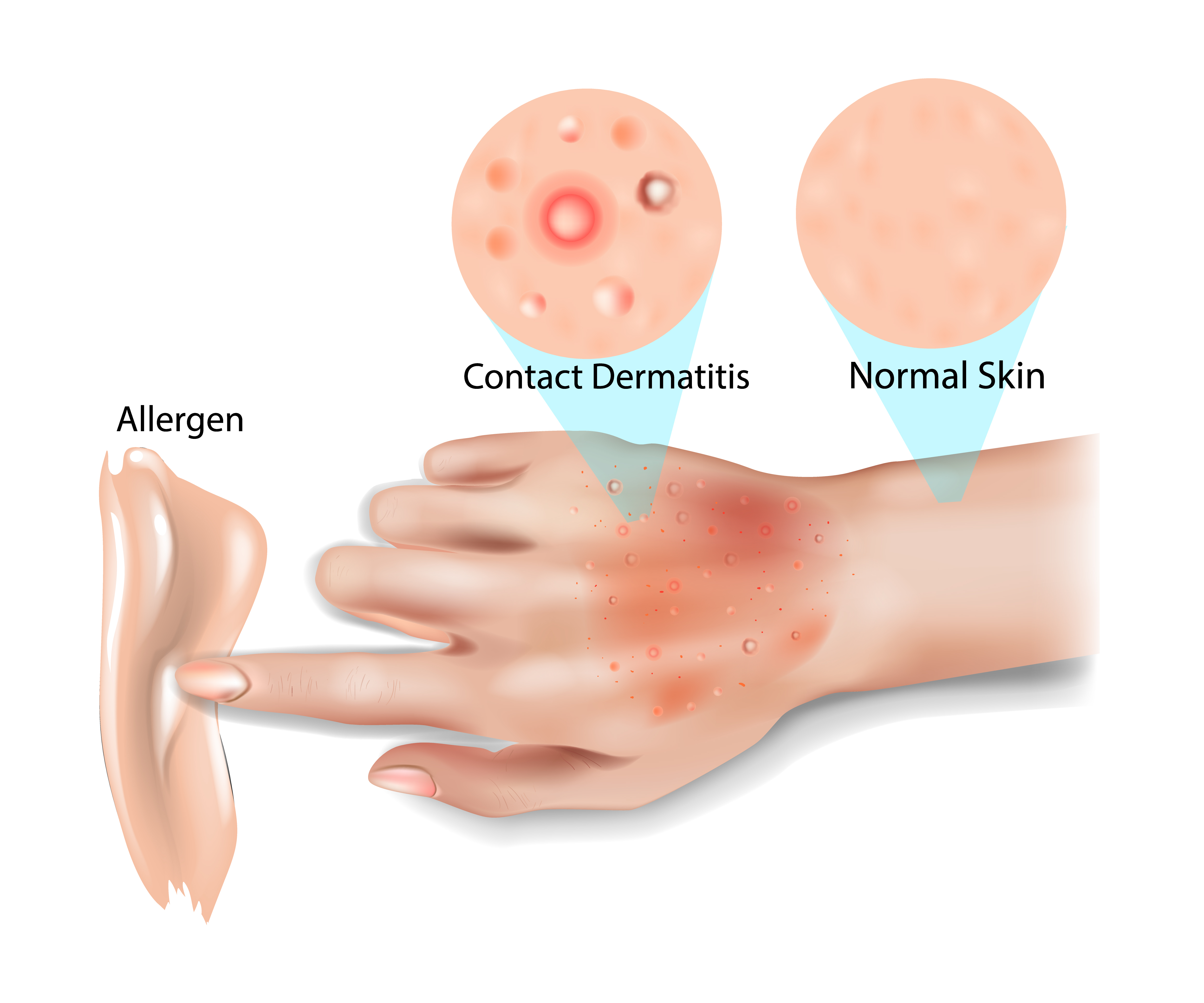 <p>PP/E: direct skin contact with irritant/allergen</p><p><u>irritant</u><br>nonspecific inflammatory skin reaction<br>bleach</p><p><u>allergic</u><br>hypersensitivity to allergy<br>poison ivy</p><p>TX: discontinue contact with offending agent+topical steroids</p>