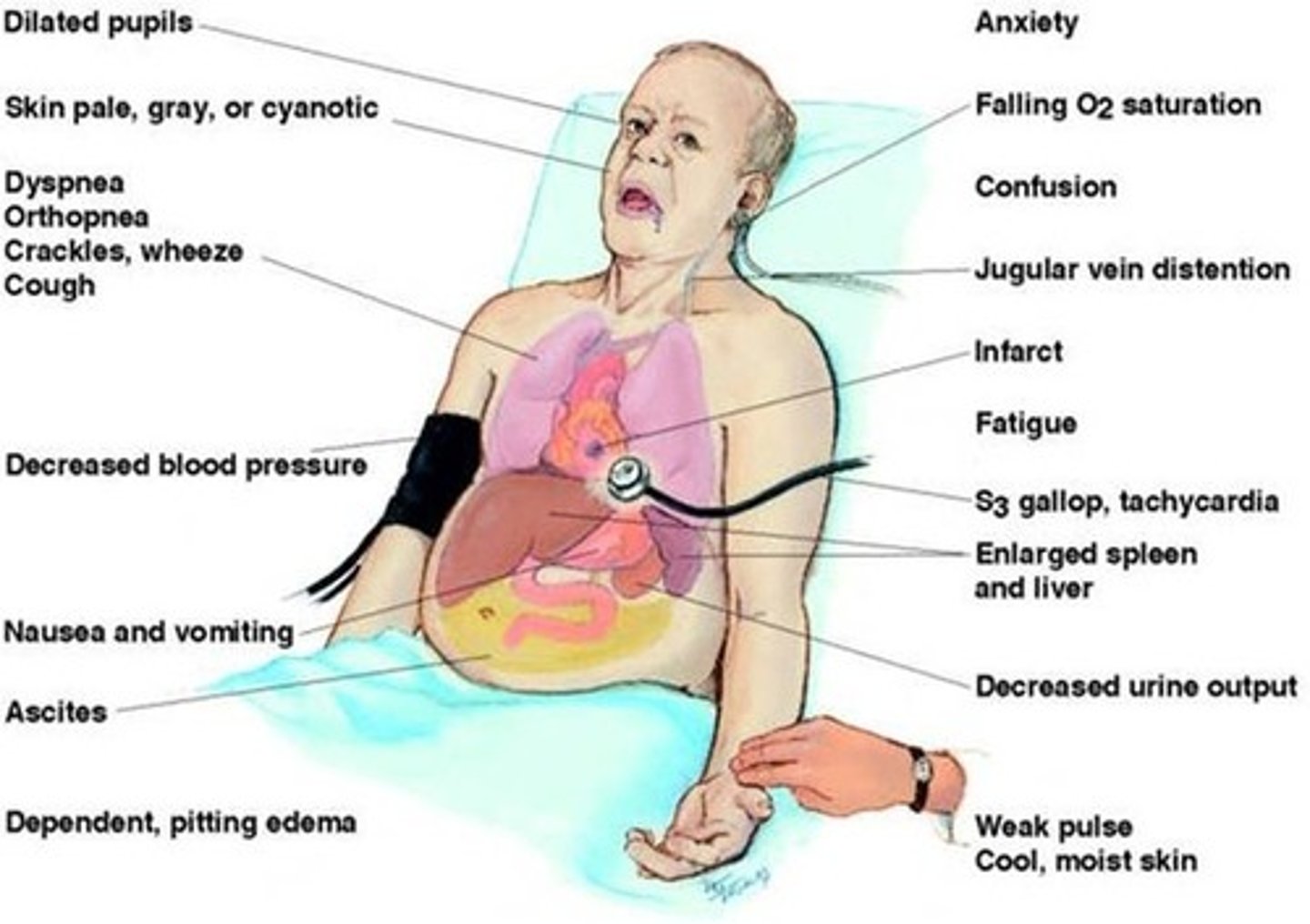 <p><strong>Congestive Heart Failure (CHF)</strong></p><p>-failure of the left ventricle to pump </p><p>-back up of blood into the lungs</p><p>-heart and lung problem </p>