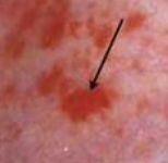 <p>slighlty larger than petechiae</p>