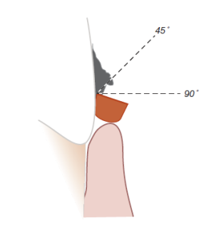 <p>one cutting edge will contact the lining pocket causing tissue damage </p>