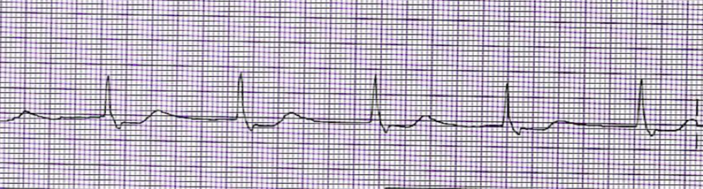 <p>What is this rhythm?</p>