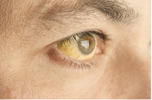 <ul><li><p><span>How would you document the assessment finding?</span></p></li><li><p><span>Which part of the eye is affected?</span></p></li></ul><p></p>