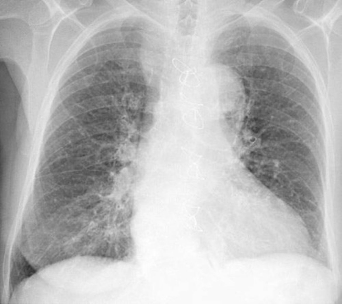 <p>(viêm phế quản )______ is a persistent condition (tình trạng kéo dài ) in which tubes in the lungs swell and make it difficult to breathe.</p>