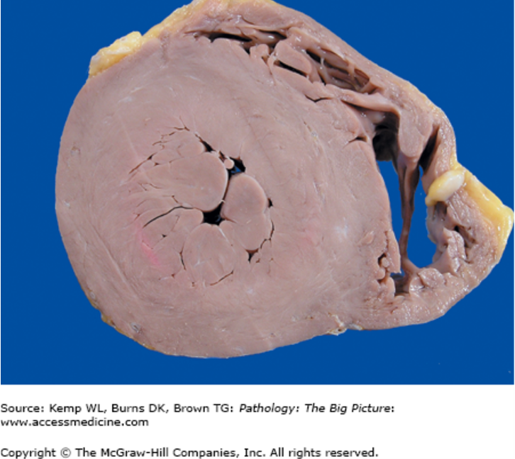 <p>increase in heart size due to aortic stenosis</p>