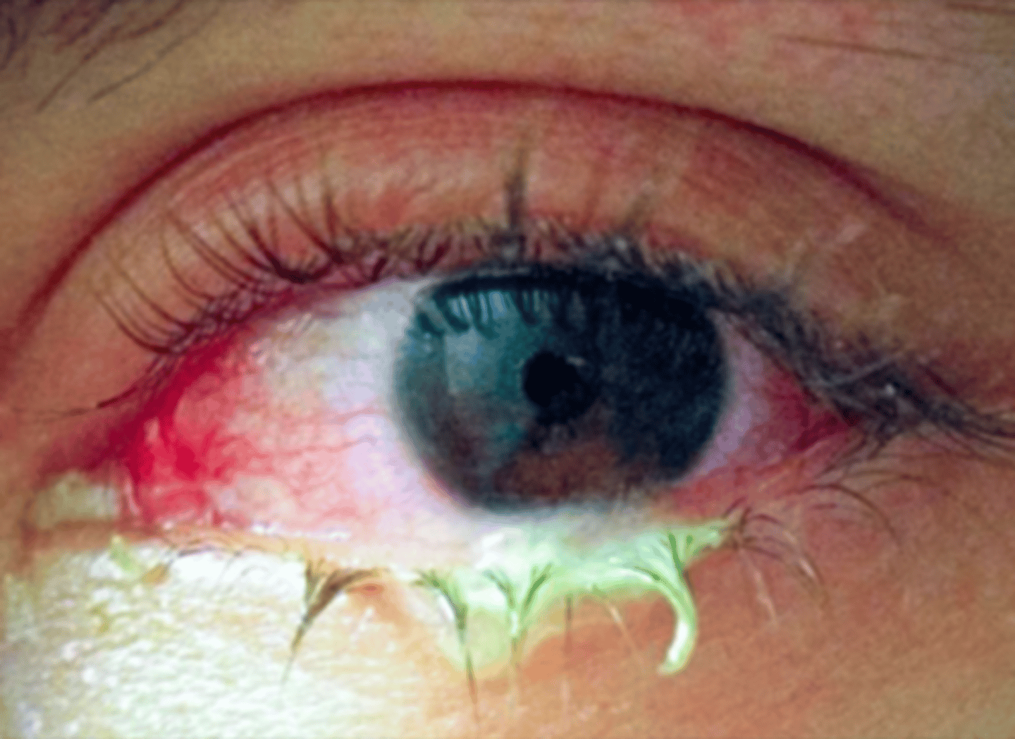 <p>What ocular condition is most likely diagnosis shown here?</p>