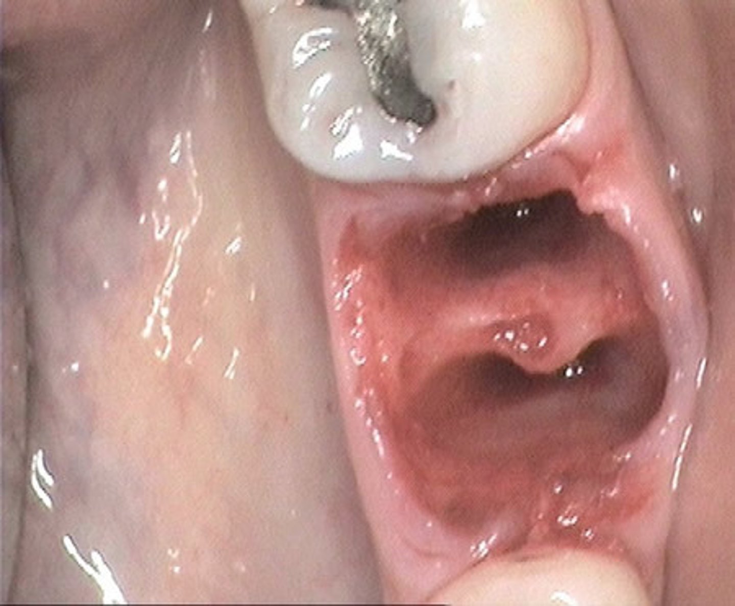<p>Alveolar Osteitis ("Dry Socket")</p>