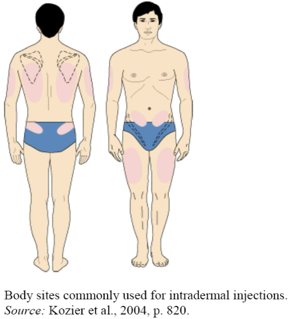 <ul><li><p>Injection area: Located just below the surface of the skin (at the interface between the epidermis and dermis). This route is most often used for skin tests in which systemic absorption is undesirable and could be dangerous (e.g., serious allergic reactions).</p></li><li><p>Volumes: Limited to small quantities, usually 0.1 mL, but may be as small as 0.02 mL and as large as 0.5 mL.</p></li><li><p>Syringes size: 1 mL syringes, often labeled "tuberculin" because these syringes were used to administer tuberculin skin tests.&nbsp;</p><ul><li><p>Unlike other syringes, these are available with and without needles attached.&nbsp;</p></li><li><p>If a syringe is sent to a nursing unit with a needle attached, you <strong>must</strong> be certain the needle cover is snapped in place.&nbsp;</p></li><li><p>If it is not sent with a needle, the syringe should be filled with <strong>0.1 mL excess for priming</strong> the new needle.&nbsp;</p></li><li><p>The syringe should then be labeled with a statement to this effect: "This syringe contains 0.1 mL excess for priming."</p></li></ul></li><li><p>Needle Sizes: 25–28 gauge, 3/8 to 5/8 inch length</p></li></ul><p></p>