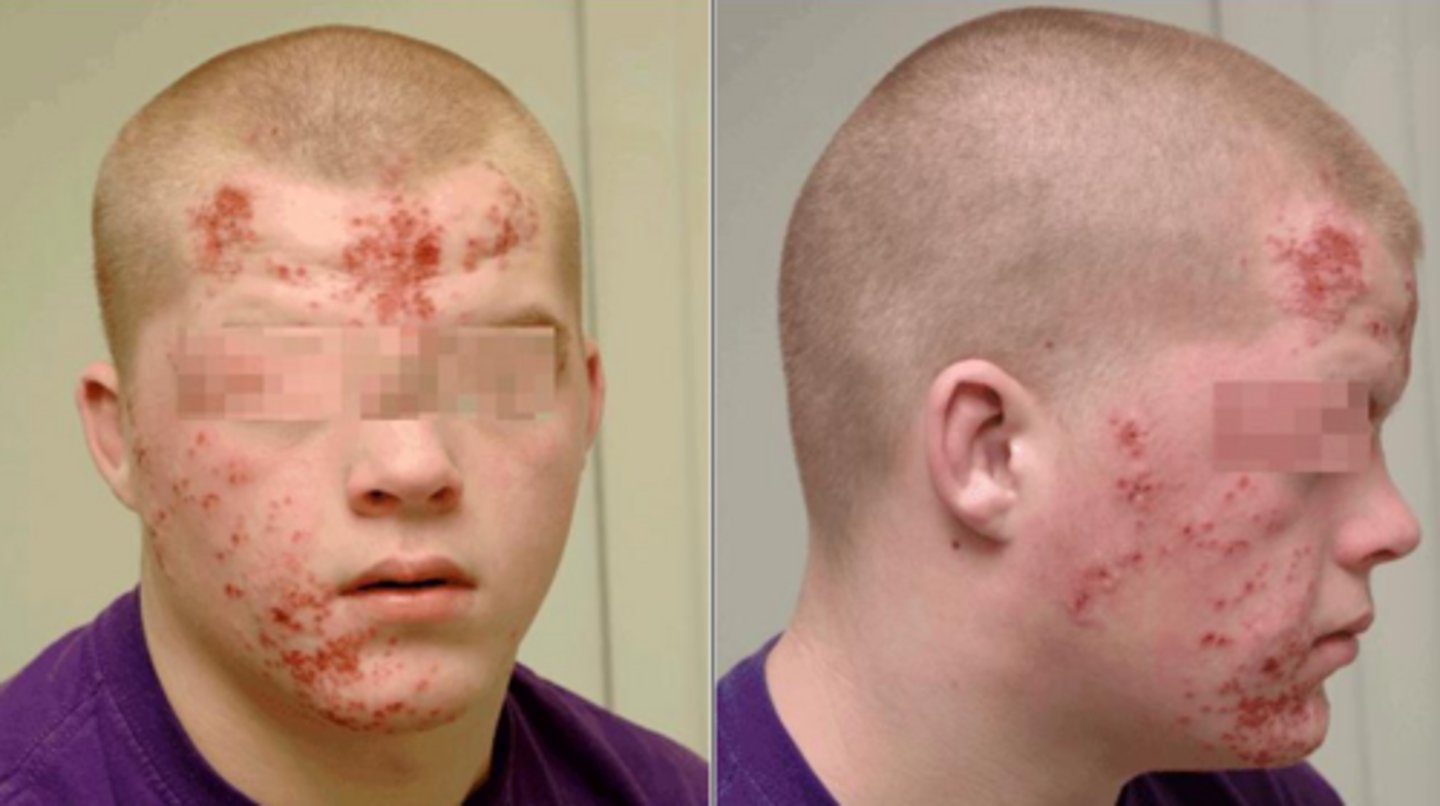 <p>herpes gladiatorum/scrumpox</p>