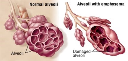 <p>Emphysema</p>
