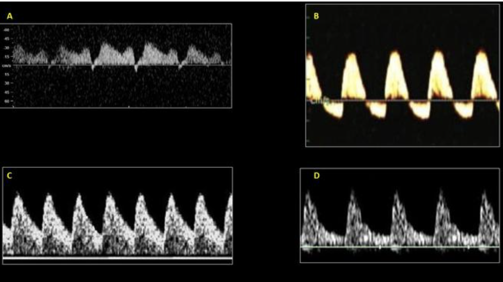 <p>which is normal middle cerebral artery waveform</p><p>a) a</p><p>b) b</p><p>c) c</p><p>d) d</p>