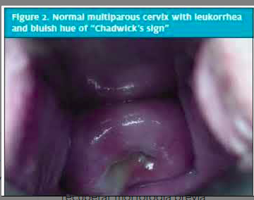 <p>SIGNO DE CHADWICK&nbsp;</p>