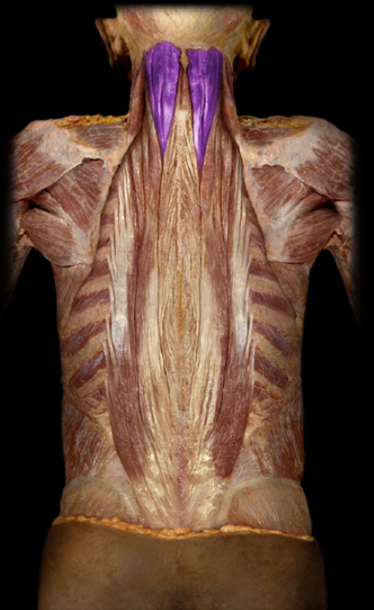 <ul><li><p>Action: Unilateral: rotation of head to opposite side, Bilateral: extension of head and neck</p></li><li><p>Origin: Transverse processes of C7-T6 vertebrae</p></li><li><p>Insertion: Occipital bone</p></li><li><p>Innervation: Cervical spinal nerves (dorsal rami)</p></li></ul><p></p>