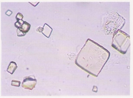 <p>Amorphous Urates </p>