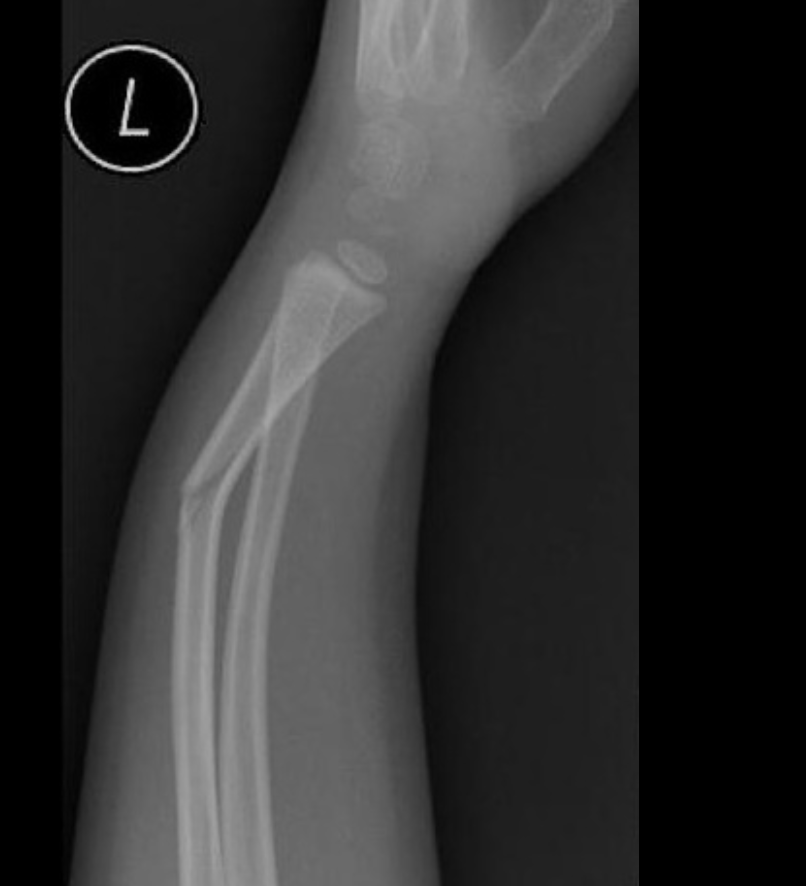 <p>An incomplete fracture of the cortex - typically in children</p>