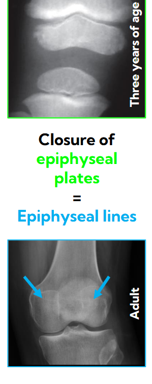 <p>A separation between the main part and secondary part of the bone</p><p>Literally means “Outside of growth” : Growth outside of the original bone</p><p>These close and create epiphyseal lines </p><p></p><p></p><p></p>