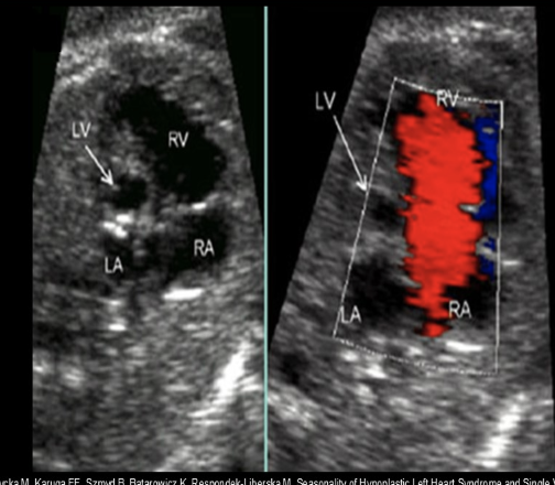 <p>while scanning the 4 chamber heart view, you see an enlarged right heart w/very<strong> small left ventricle + atrium.</strong> you move to the LVOT view and the ascending AO is much smaller than normal</p><p>.</p><p>a) marfan syndrome</p><p>b) pulmonary HTN</p><p>c) Ebstein anomaly</p><p>d) hypoplastic left heart</p>