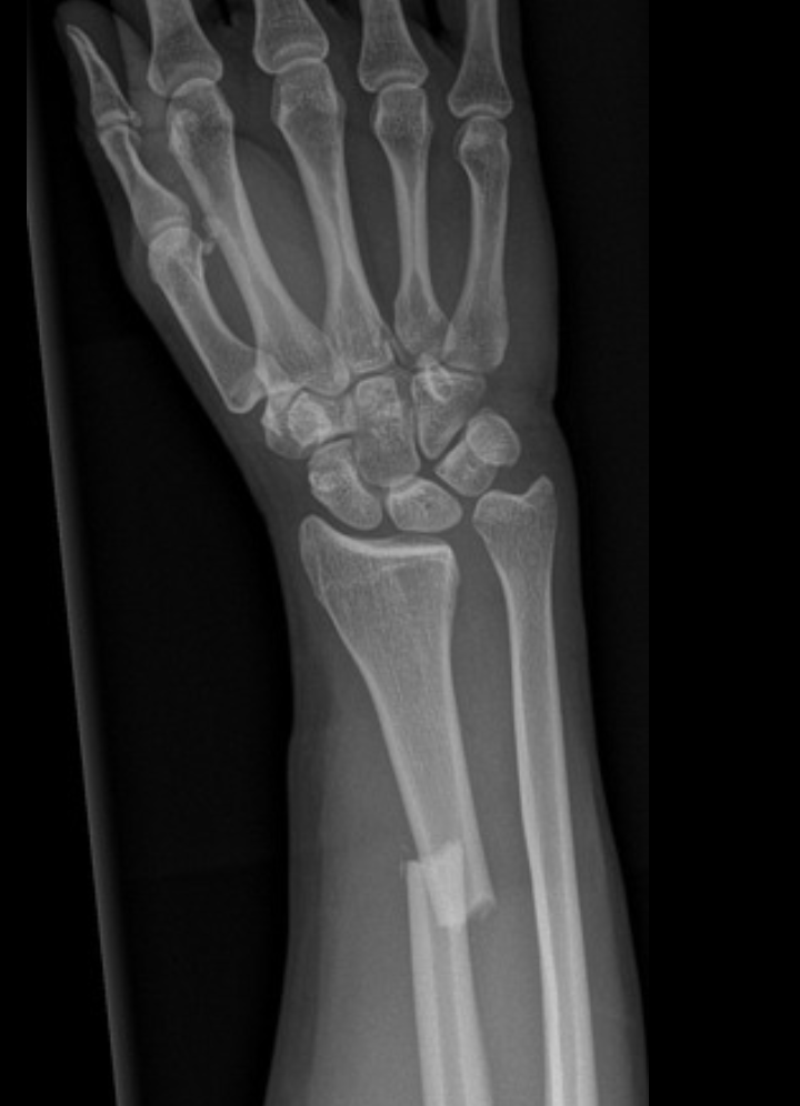 <p>A fracture of the distal 1/3 radial shaft with injury of the DRUJ (bust it wide open) - get and document nerve function</p>