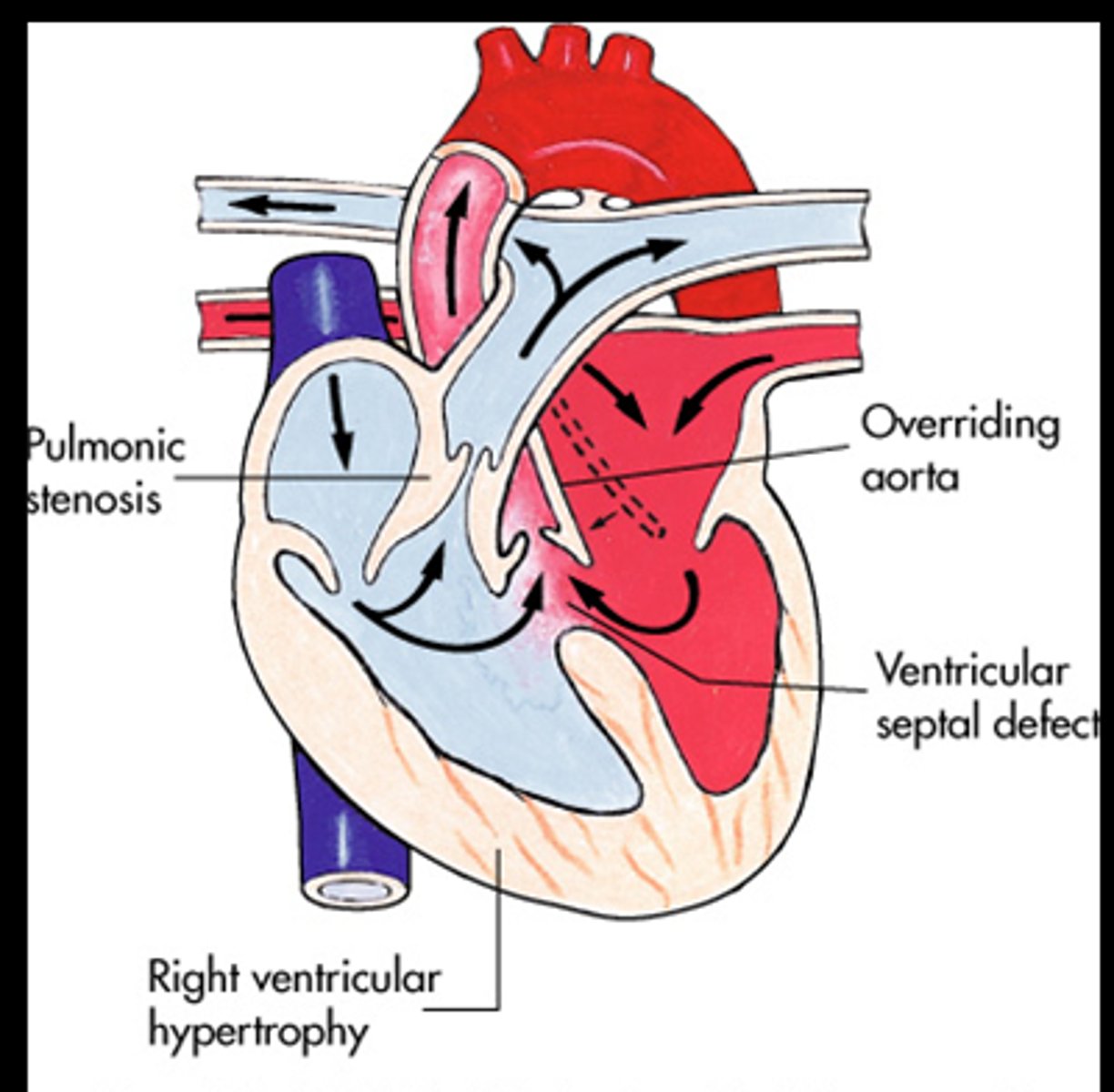 <p>- Pulmonary stenosis increases pressure in right ventricle</p><p>- Blood shunts R→ L through VSD</p><p>- Deoxygenated blood circulates body, causing severe cyanosis, seizures, and death</p>