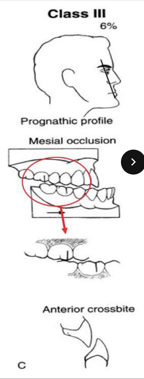 <p>Prognathic profile, 6% angle, posteior mesial occlusion (MB cusp of max 1st is over the embrasure btwn the mand 1st and 2nd molar), anterior crossbite</p>