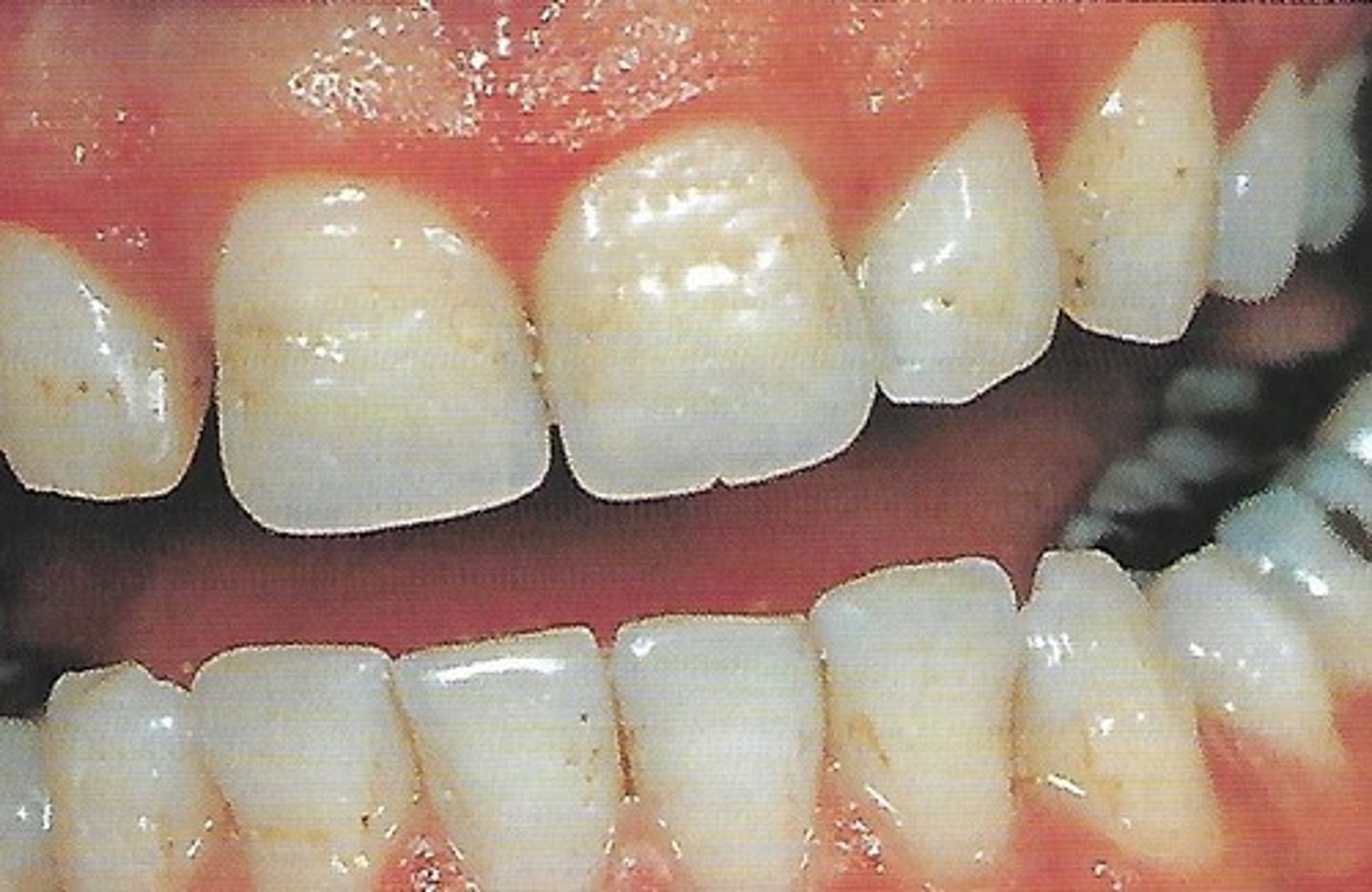 <p>-multiple pits on the labial surface of the teeth</p><p>-4 types</p>