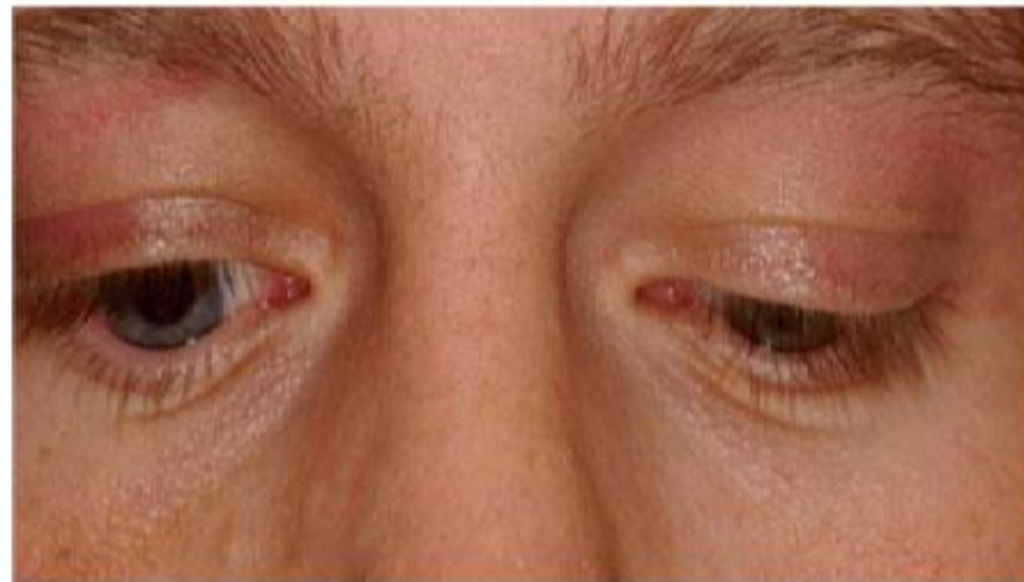 <p>facial palsy like Bell's CN 7 palsy</p><p>myotonic dystrophy = once pt opens eyes, lids remain up there</p><p>TED = UL infiltration and retraction</p><p>aberrant regeneration of CN 3</p>