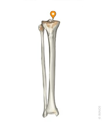 <p>Bump on the proximal surface of the Tibia that makes up the medial side of the Intercondylar Eminence.</p>
