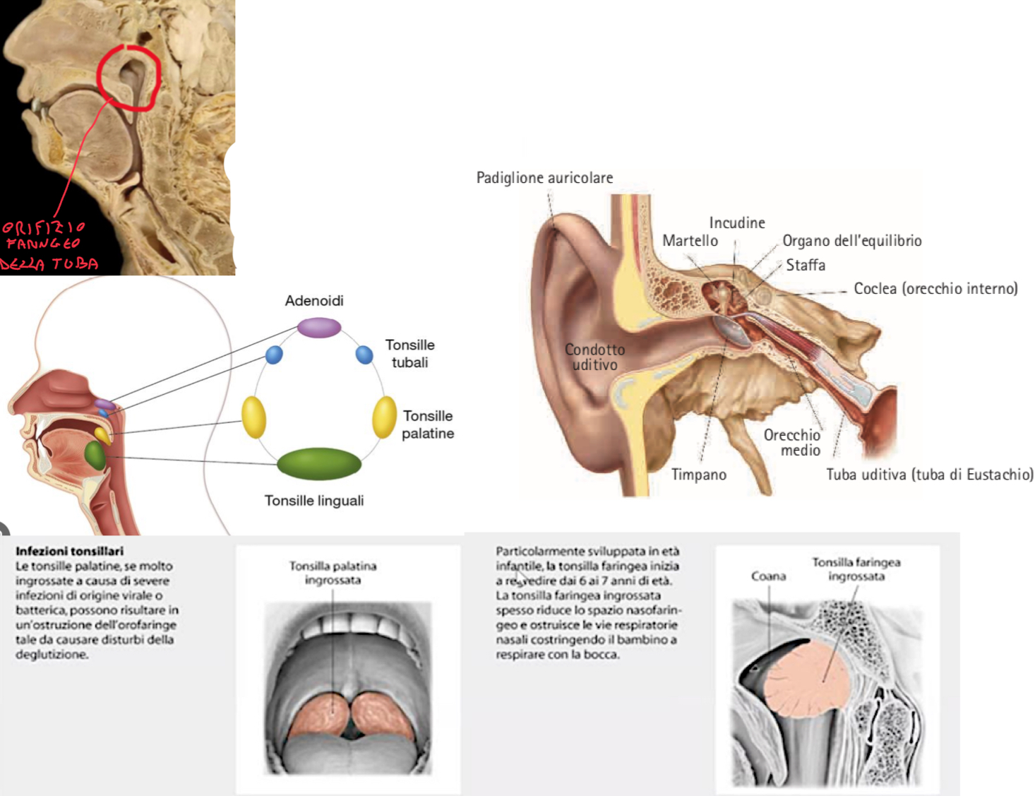 <p>Sulla parete laterale del Rinofaringe:</p><ul><li><p>è presente l’orifizio della tuba uditiva (o di Eustachio) che si scava nell’osso temporale e serve ad equilibrare la pressione nell’orecchio medio → condizione necessaria per la vibrazione corretta della membrana timpanica e la trasmissione del suono agli ossicini.</p></li><li><p>Quindi serve a rendere la pressione dell’aria ai due lati della membrana uguale</p></li></ul><p>Struttura tuba uditiva:</p><ul><li><p>Prevalentemente cartilagine a ferro di cavallo, completata da connettivo fibroso</p></li><li><p>Le pareti sono generalmente collassate, ma durante la deglutizione attraverso la contrazione del tensore ed elevatore del velo palatino, si dilatano permettendo il passaggio di aria nell’orecchio medio → per questo masticare una gomma sull’areo equilibria la pressione</p></li></ul><p>Toro Tubarico (torus tubarius):</p><ul><li><p>E’ un rilievo della mucosa sulla parete laterale del rinofaringe causato dalla cartilagine della tuba uditiva</p></li><li><p>Si continua con due pieghe causate dalla muscolatura sottostante:</p><ul><li><p>Anteriore → Piega Salpingopalatina</p></li><li><p>Posteriore → Piega Salpingofaringea</p></li></ul></li></ul><p>Decorso:</p><ul><li><p>A livello dell’Orifizio Faringeo del Rinofaringe origina la porzione cartilaginea della tuba uditiva che si continua posterolateralmente passando tra la fessura sfenopetrosa e petrosquamosa per poi terminare nell’orecchio medio</p></li></ul><p>Anello di Waldeyer, tessuto linfoide associato:</p><ul><li><p>Tonsilla Tubarica → sotto la mucosa del toro tubarico</p></li><li><p>Tonsilla Faringea (adenoide) → all’origine della faringe</p></li><li><p>Tonsille Palatine → passaggio tra orale e orofaringe</p></li><li><p>Tessuto Linfoide Diffuso → lungo le pareti faringee e adito laringeo</p></li><li><p>Tutte insieme formano l’anello di Waldeyer, una barriera contro patogeni aereo-digerente.</p></li><li><p>Clinica tonsilla faringea → con l’età tende a regredire, in caso di ipertrofia causa ostruzione rinofaringe e rende difficoltosa la respirazione orale</p></li></ul><p></p>