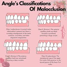 <p>normal occlusion (static, Class 1)</p>