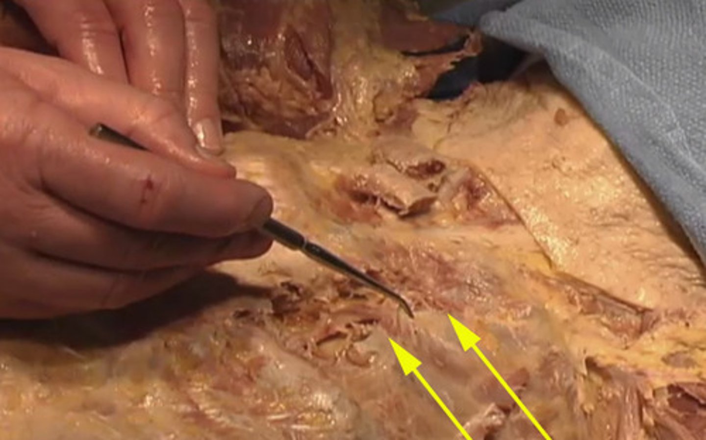 <p>To where are these arrows pointing?</p><p>intercostal spaces</p><p>pectoralis major</p><p>spine</p><p>pectoralis major</p>