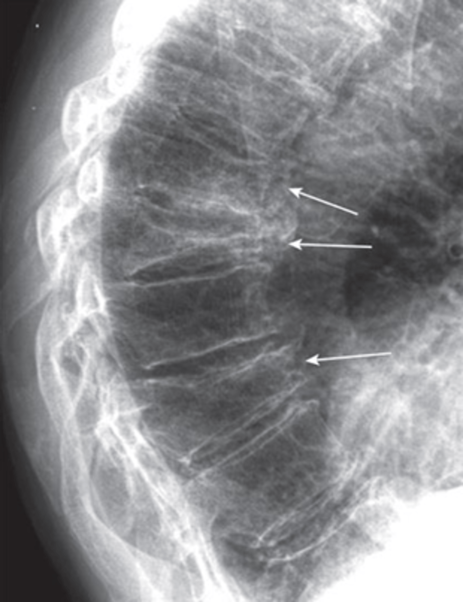 <p>What pathology is seen here?</p>